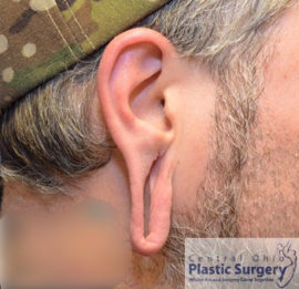 Earlobe Repair