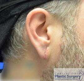 Earlobe Repair