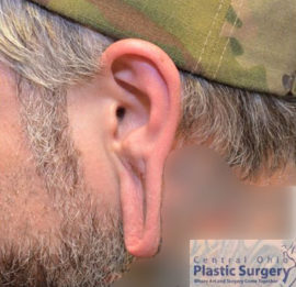 Earlobe Repair