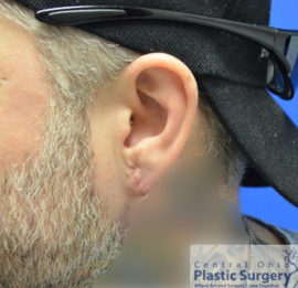 Earlobe Repair