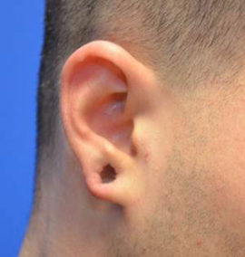 Earlobe Repair