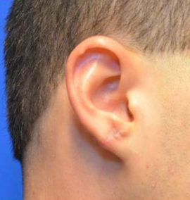 Earlobe Repair