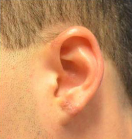 Earlobe Repair