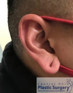 Earlobe Repair