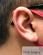 Earlobe Repair