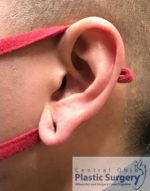 Earlobe Repair