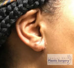 Earlobe Repair