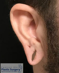 Earlobe Repair