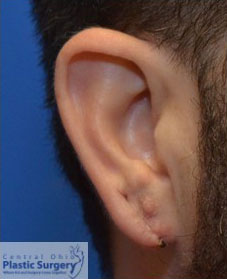 Earlobe Repair