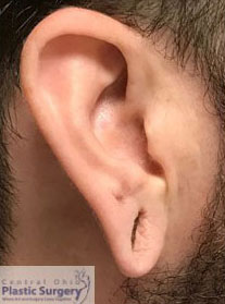 Earlobe Repair