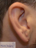 Earlobe Repair