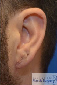 Earlobe Repair