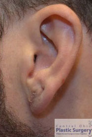 Earlobe Repair