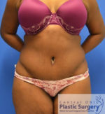 Tummy Tuck