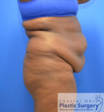 Tummy Tuck