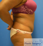 Tummy Tuck