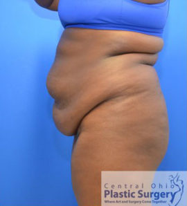 Tummy Tuck