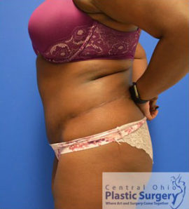 Tummy Tuck