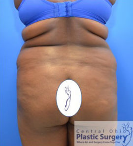 Tummy Tuck