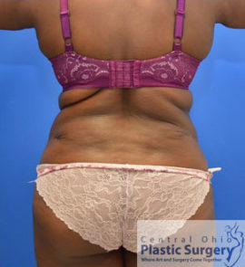 Tummy Tuck