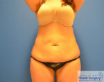 Tummy Tuck