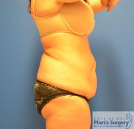 Tummy Tuck