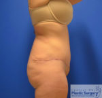 Tummy Tuck