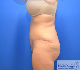 Tummy Tuck