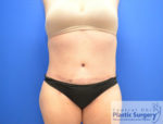 Tummy Tuck