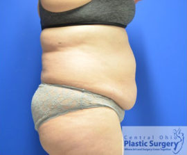 Tummy Tuck