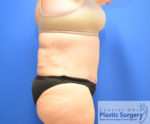 Tummy Tuck