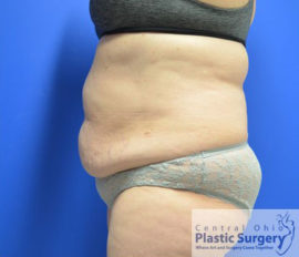 Tummy Tuck