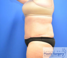 Tummy Tuck