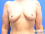 Breast Augmentation