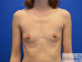 Breast Augmentation