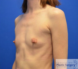 Breast Augmentation