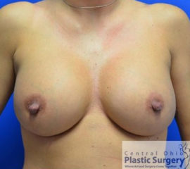 Breast Augmentation