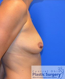 Breast Augmentation