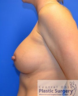 Breast Augmentation