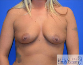 Breast Augmentation