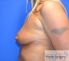 Breast Augmentation