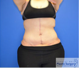 Tummy Tuck