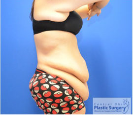 Tummy Tuck