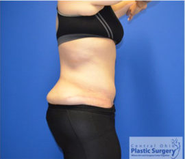 Tummy Tuck