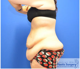 Tummy Tuck