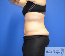 Tummy Tuck