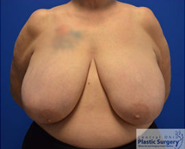 Breast Reduction