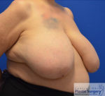 Breast Reduction