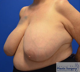 Breast Reduction