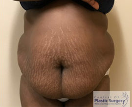 Tummy Tuck